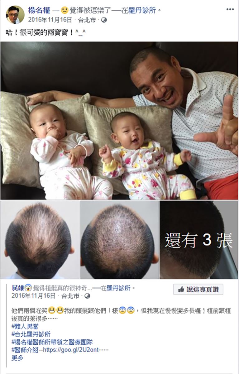 植髮,禿頭,落髮,六合一三階段雄性禿治療 楊氏羅丹